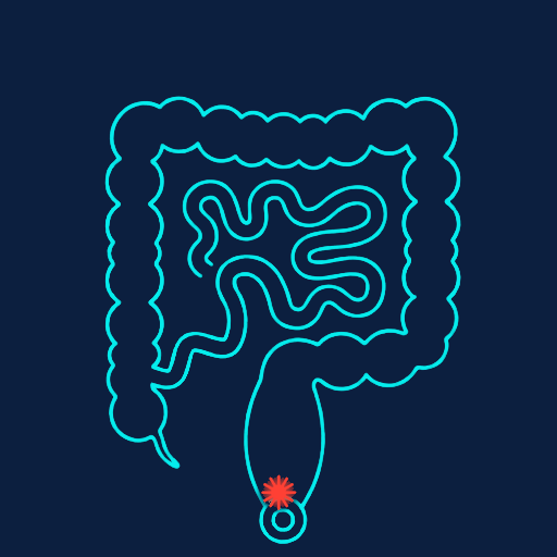 Crohn's colon with perianal involvement — fistula, abscess, and skin changes around the anus